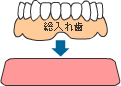 従来の治療 ＜総入れ歯＞