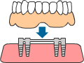 インプラント治療