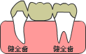 従来の治療 <ブリッジ>