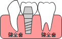 インプラント治療