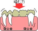 従来の治療 <ブリッジ>
