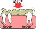 従来の治療 ＜ブリッジ＞