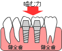 インプラント治療