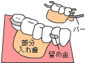 従来の治療 <部分入れ歯>