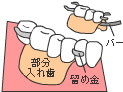 従来の治療 ＜部分入れ歯＞