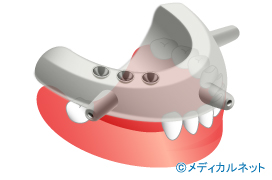 インプラントを埋め入れるための手術用テンプレートとは？