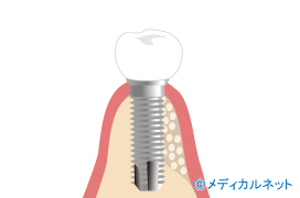 顎の骨が足りない場合に行う骨造成とは？