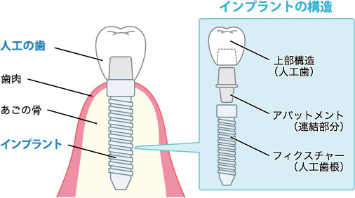 インプラントの構造