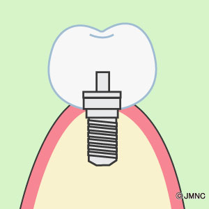 インプラント手術 1回法-4