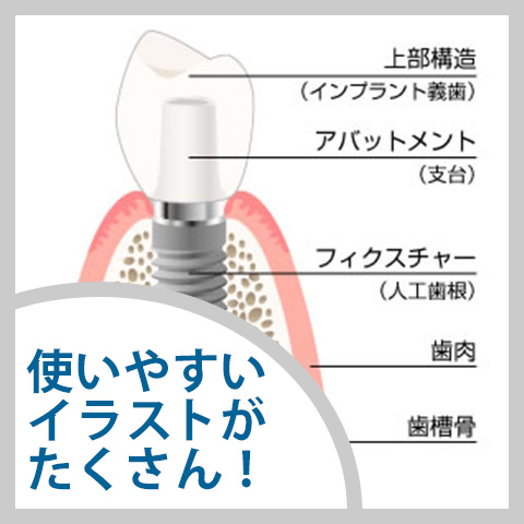 インプラントとは